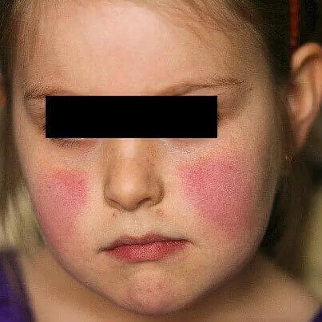 Rumień na twarzy u dziecka