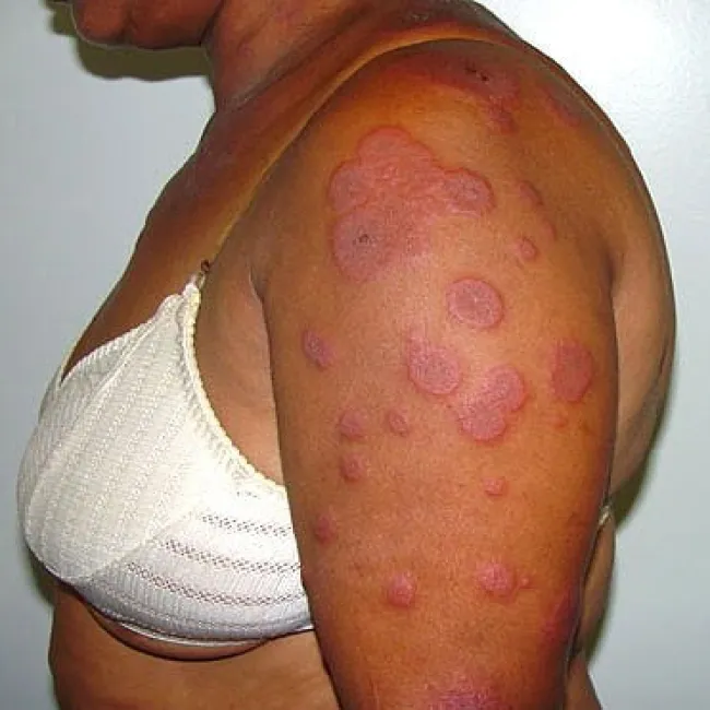 Rumień wielopostaciowy na ramieniu