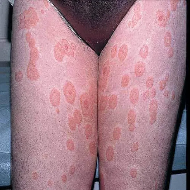 Rumień wielopostaciowy na udach