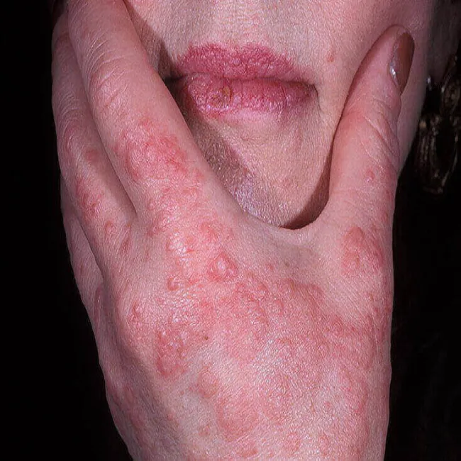 Rumień wielopostaciowy, nie określony