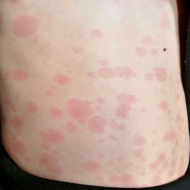 Rumień zakaźny u dorosłego na skórze