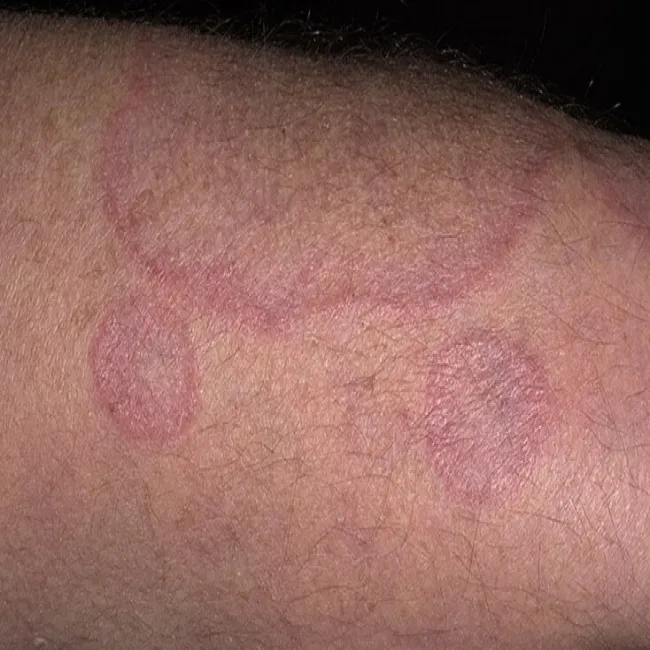 Rumienie na skórze ziarniniak obrączkowaty 