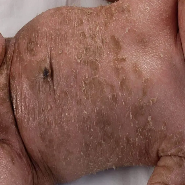 Rybia łuska blaszkowata choroba skóry u dziecka