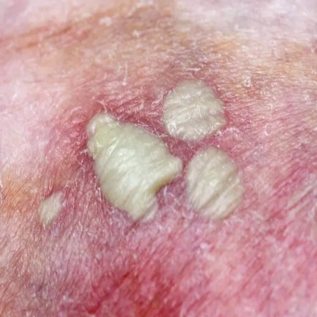 Rzadkie choroby skóry zdjęcia