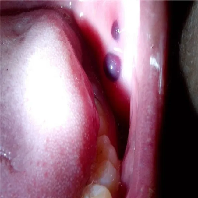 Rzeżączka w jamie ustnej