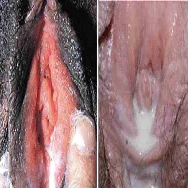 Rzeżączka objawy u kobiet