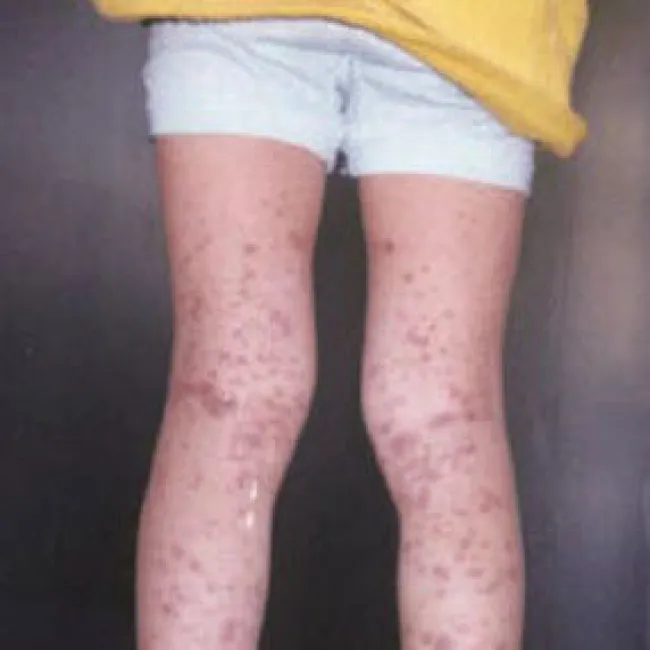 Samoistna plamica małopłytkowa u dzieci