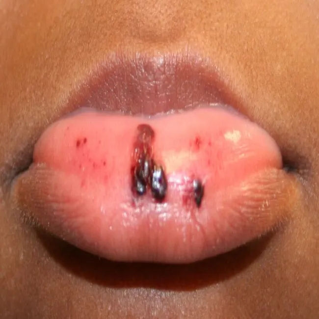 Samoistna plamica małopłytkowa