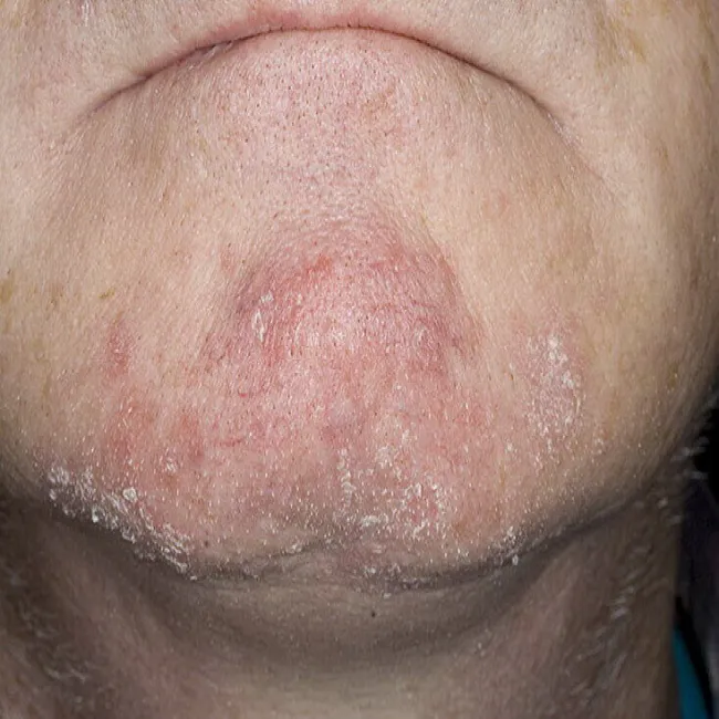 Schodząca skóra z brody 