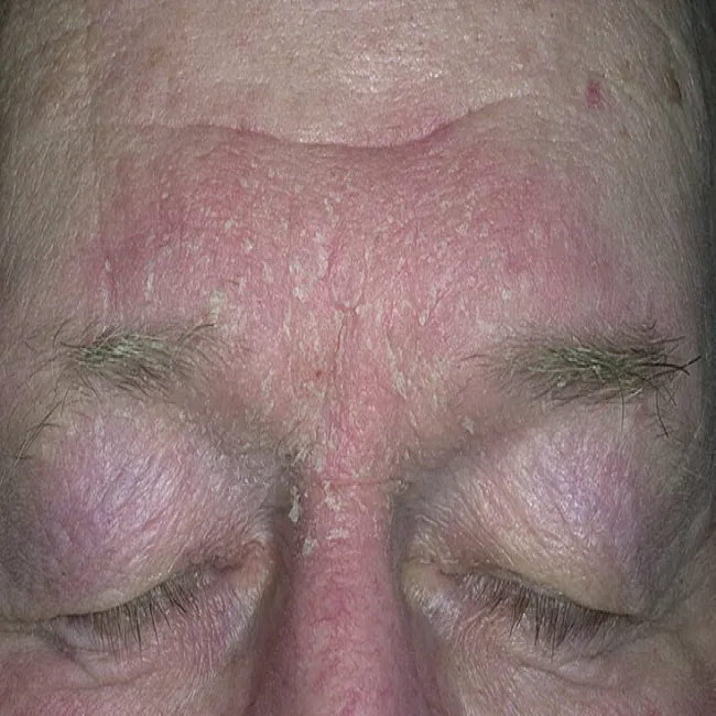 Schodząca skóra z twarzy