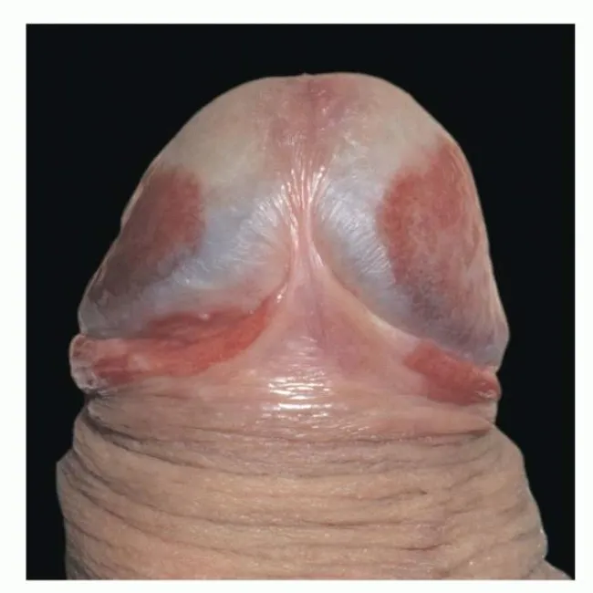 Sine plamy na żołędziu zapalenie żołędzi Zoon 