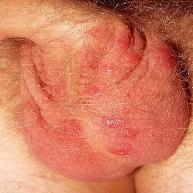 Skóra moszny choroba świerzb