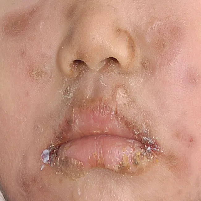 Skórne skutki uboczne działania leków