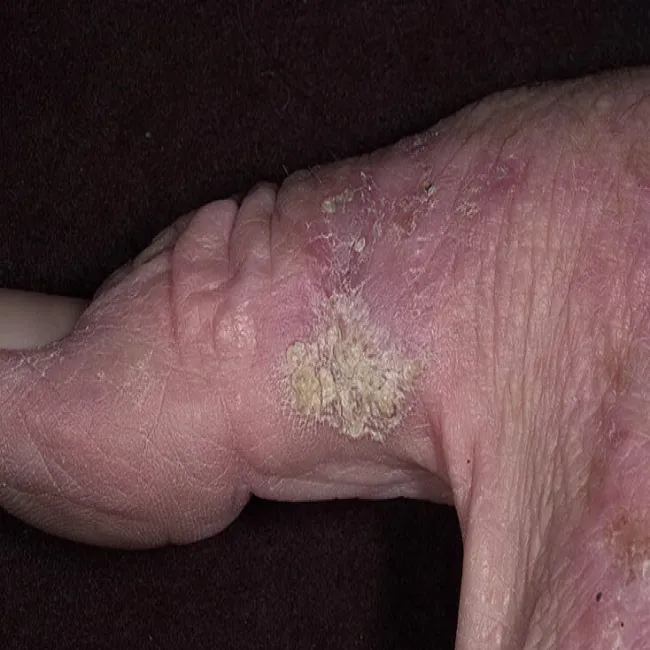 Skórne zmiany na kciuku choroba rogowacenie