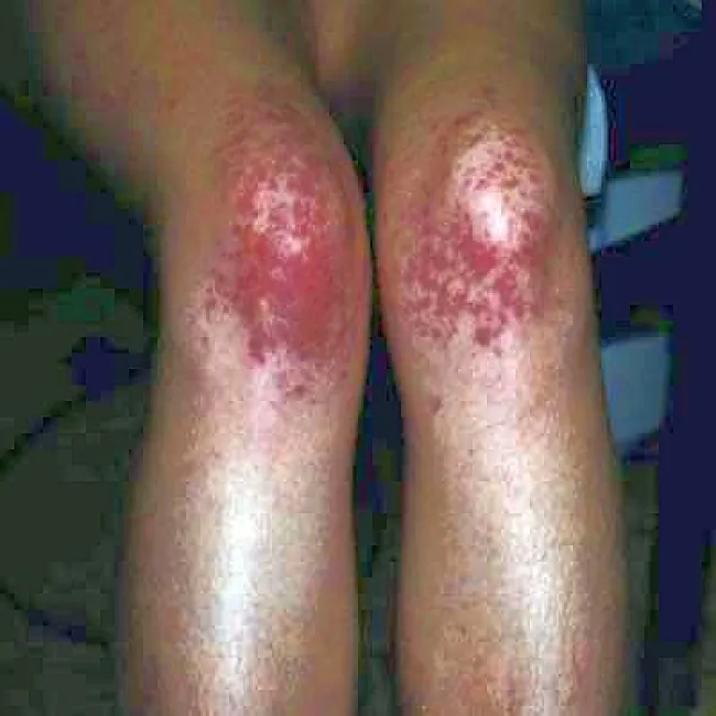 Skaza krwotoczna  małopłytkowość immunologiczna