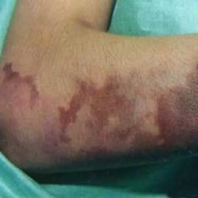 Skazy małopłytkowe małopłytkowość immunologiczna