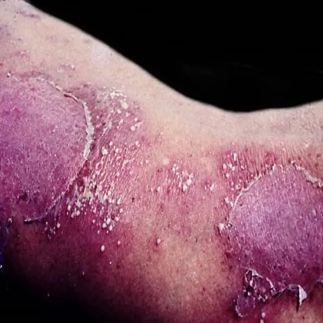 Sneddon-Wilkinson disease 