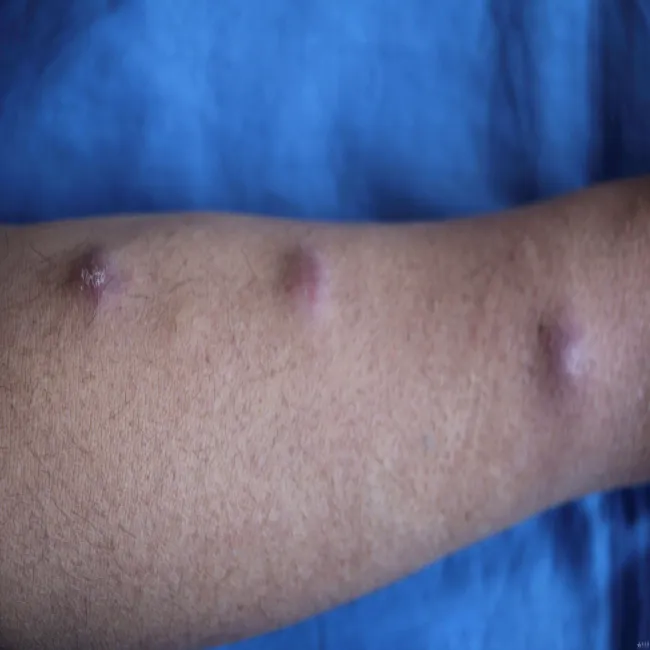 Sporotrychoza objawy