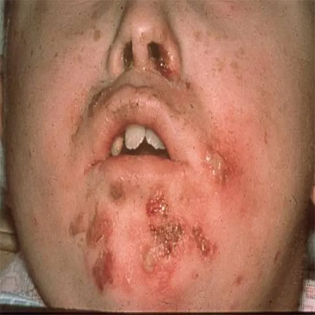 Stan zapalny skóry wywołany infekcją gronkowcową figówka