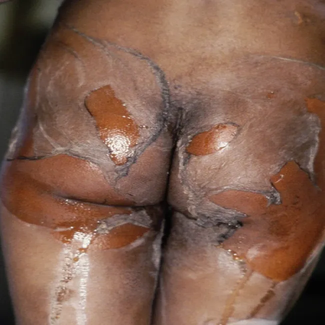 Staphylococcal scalled skin syndrome - SSSS