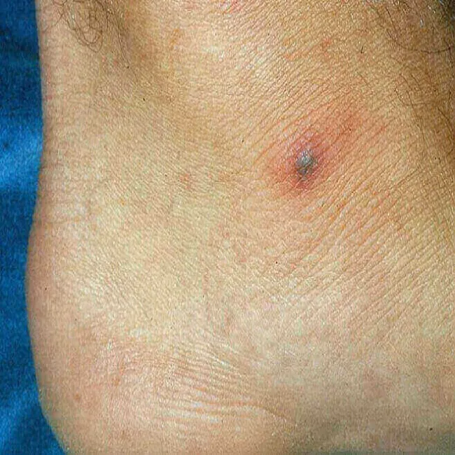 Stopa guzek rzeżączka choroba