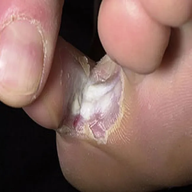 Stopa sportowca, grzybica międzypalcowa