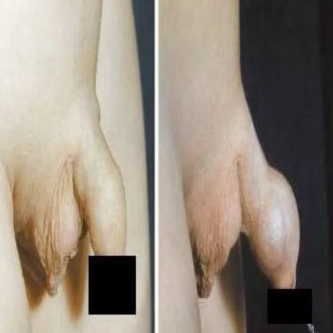 Stulejka efekt balonika