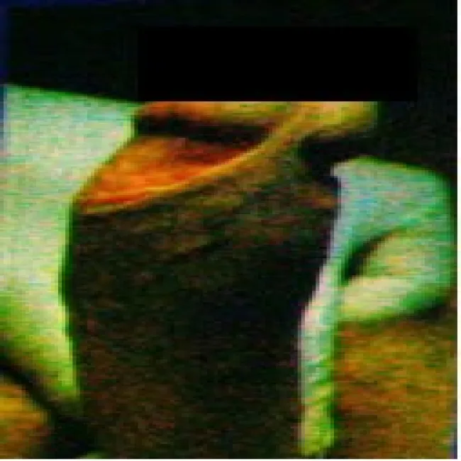 Stwardnienie członka choroba Peyroniego