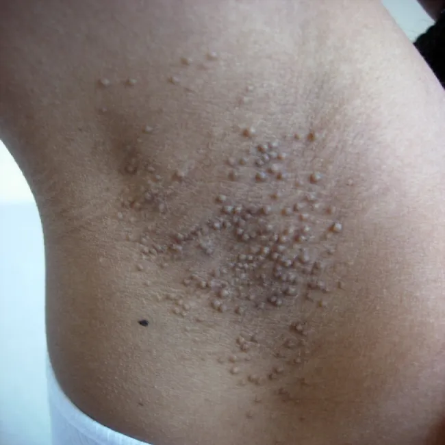 Swędzące zmiany skórne pod pachami choroba Foxa-Fordyce'a