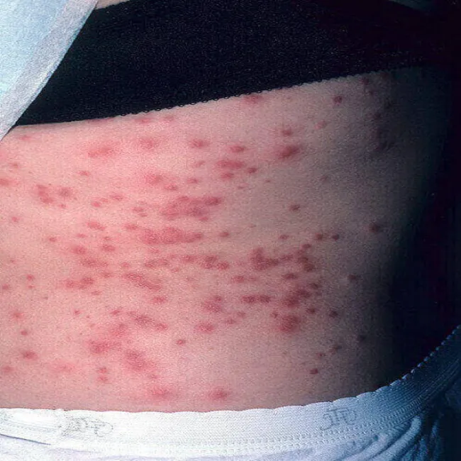 Swędzące zmiany skórne 