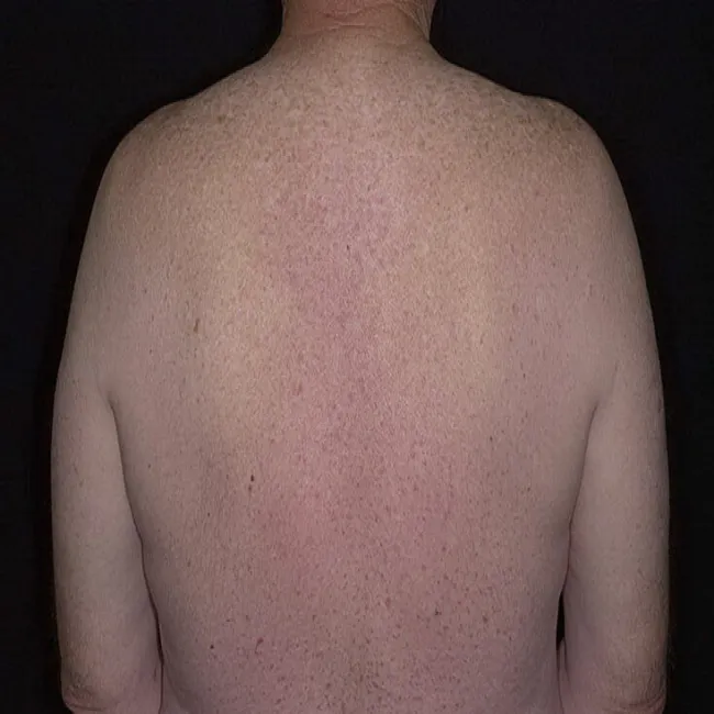 Swędząca wysypka na plecach choroba Grovera