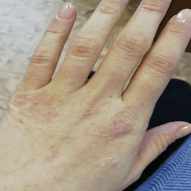 Swędzenie dłoni po rękawiczkach lateksowych