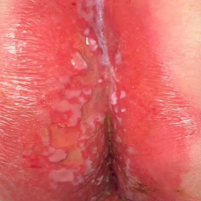 Swędzenie i pieczenie między pośladkami pozasutkowa choroba Pageta 