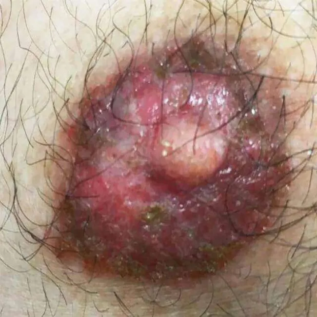 Swędzenie brodawek sutkowych u mężczyzn