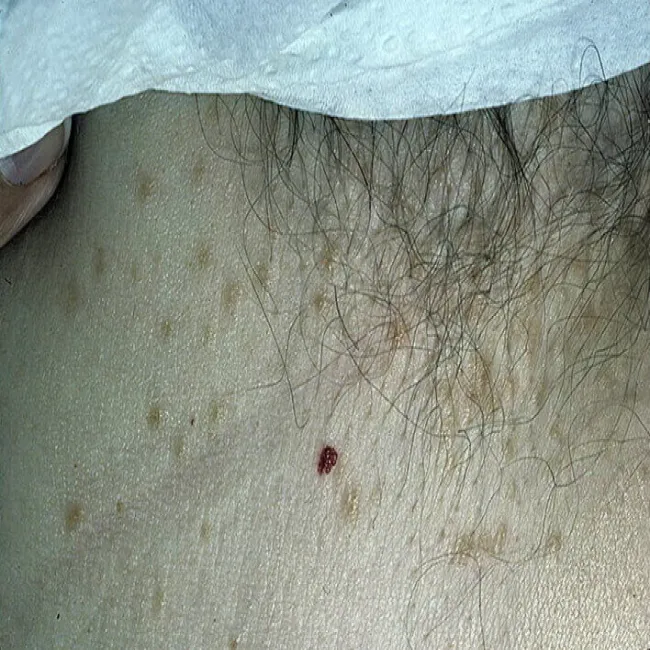 Syringoma okolic intymnych