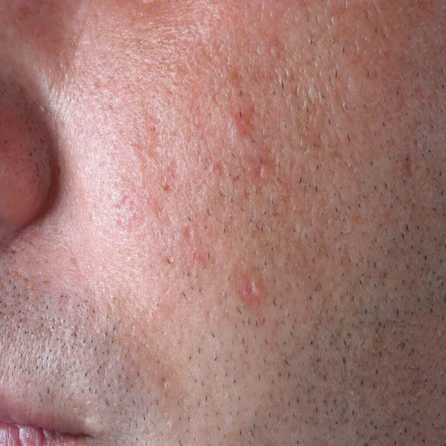 Syringoma u mężczyzny