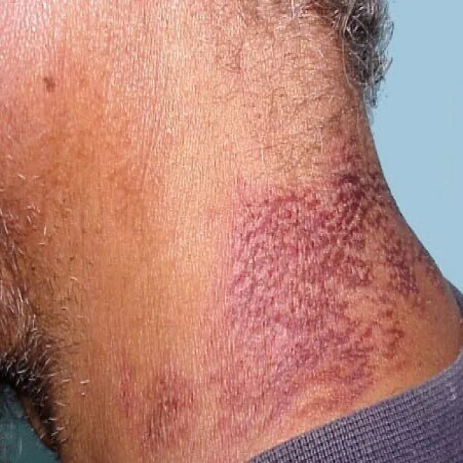 Szyja zmiany skórne pelagra