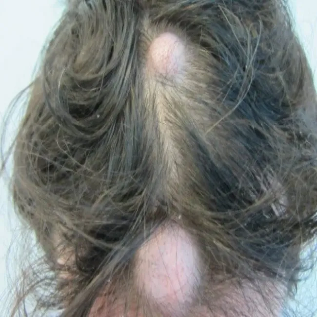 Tłuszczak na głowie choroba Dercuma