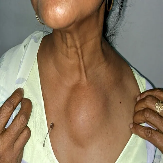 Tłuszczak na klatce piersiowej