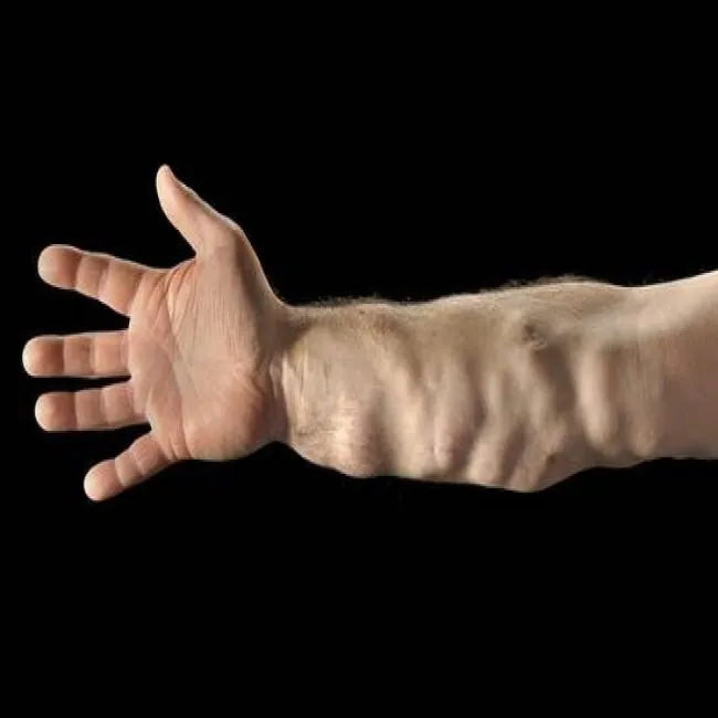 Tłuszczaki bolesne na rękach choroba Dercuma