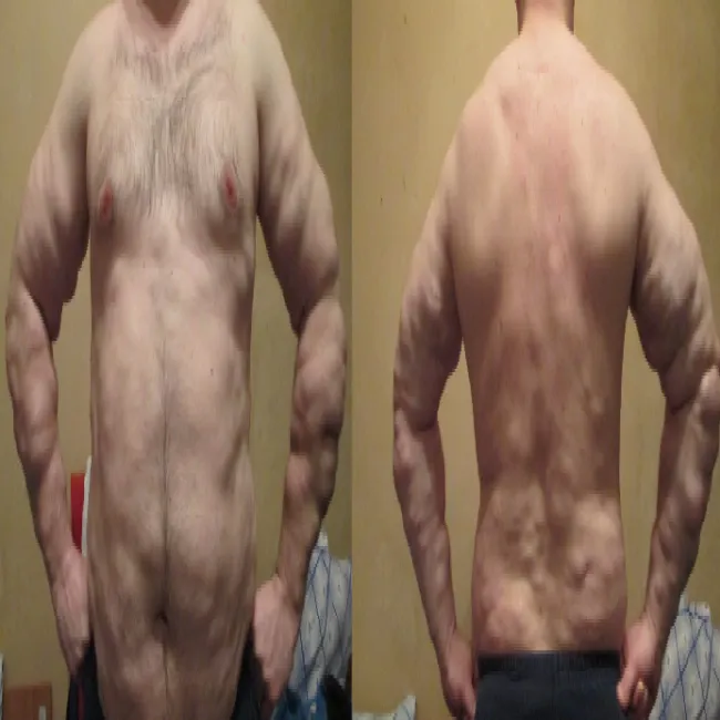 Tłuszczaki podskórne choroba Dercuma