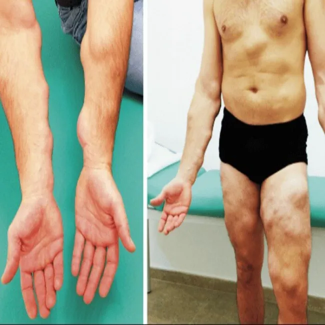 Tłuszczaki zdjęcia choroba Dercuma 