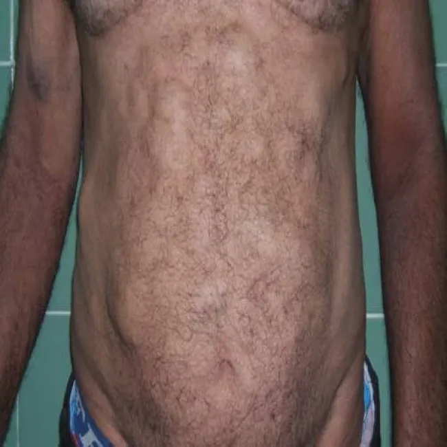 Tłuszczakowatość bolesna