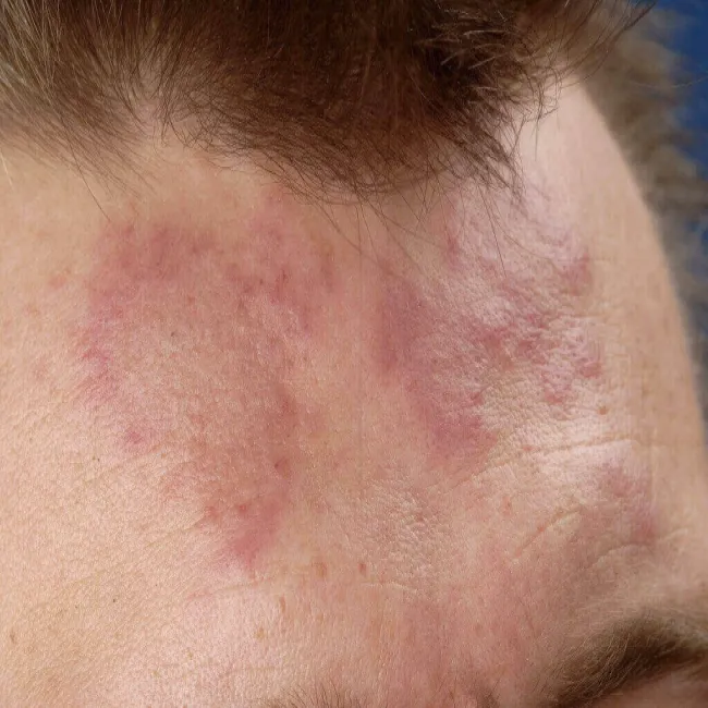 Toczeń rumieniowaty krążkowy na czole
