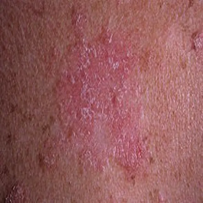 Toczeń rumieniowaty krążkowy plamy na skórze