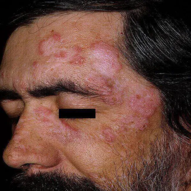 Toczeń rumieniowaty krążkowy u mężczyzny