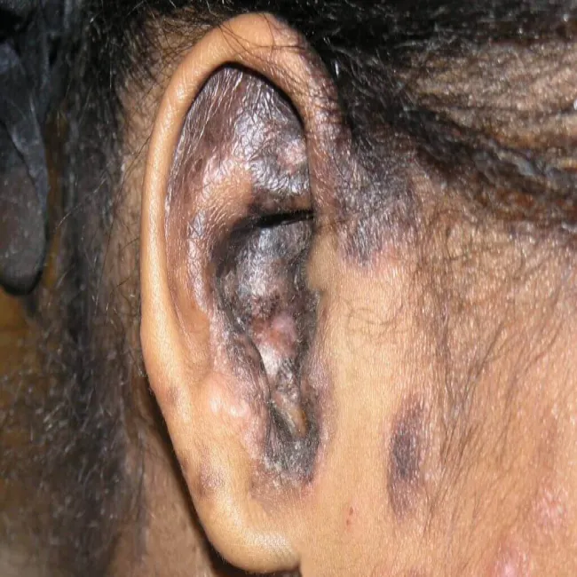 Toczeń rumieniowaty krążkowy w uchu