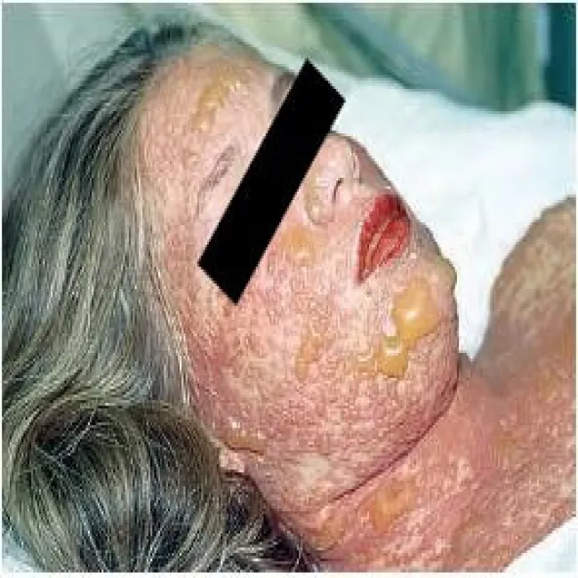 Toksyczna nekroliza naskórka na twarzy