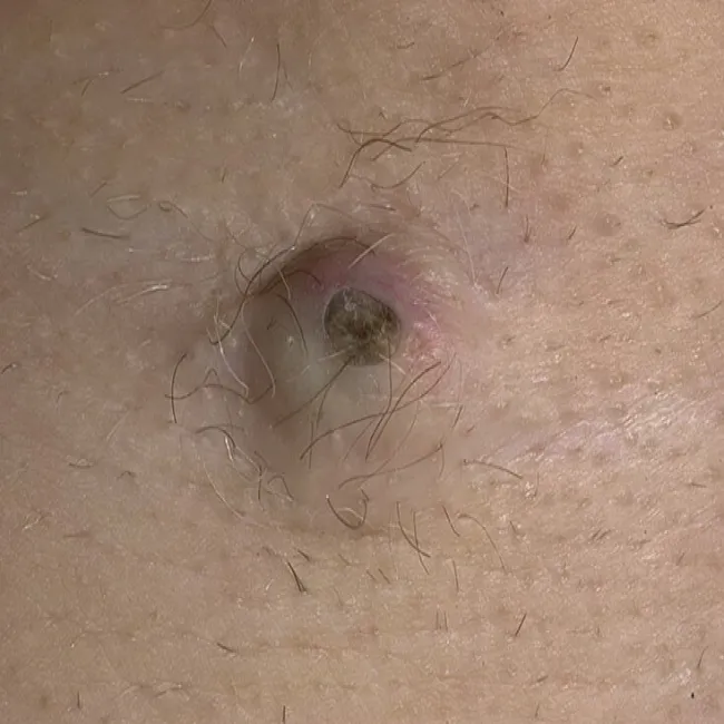 Torbiel osłonki włosa