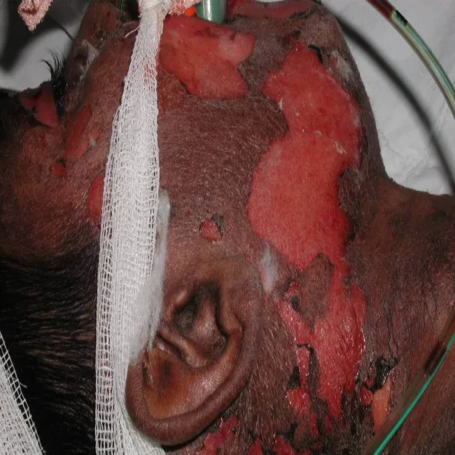 Toxic Epidermal Necrolysis